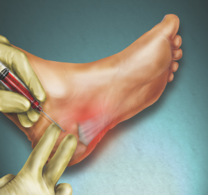 Plantar Fasciitis